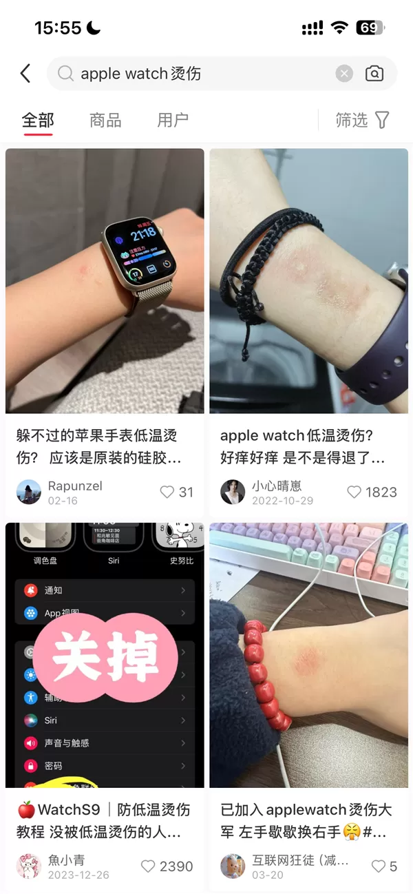 女子戴AppleWatch睡觉被烫伤起泡苹果客服回应:过敏反应