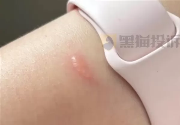 女子戴AppleWatch睡觉被烫伤起泡苹果客服回应:过敏反应