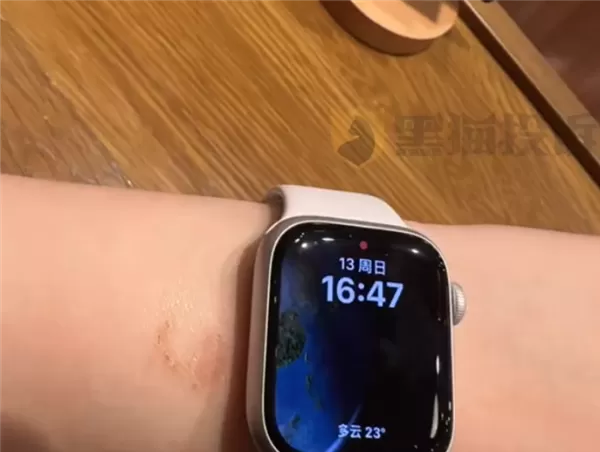 女子戴AppleWatch睡觉被烫伤起泡苹果客服回应:过敏反应